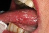 Figure 3  Oral candidiasis (pseudomembranous) is seen as elevated white plaques on the dorsal and lateral surfaces of the tongue.