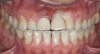 Figure 11  Preoperative photograph of a case in which the patient refused surgery and orthodontics. The treatment goal was to do minimal preparation and use a tough material due to the general medium-to-high risk in every area; obtaining a seal was possible
