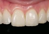 Figure 2b  Anterior porcelain veneer restoration.