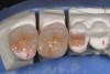 Figure 6a  Pressed ceramic restorations.