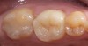 Figure 8b  IPS e.max restorations replacing existing amalgam.