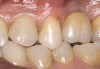 Figure 5  Final implant-supported PFM restorations.