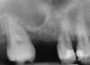 Figure 6  Preoperative radiograph of the area around tooth No. 15.