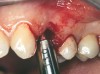 Figure 14b  Alternating osteotomes were used to prepare the implant site.