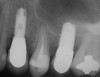 Figure 15  Posttreatment radiograph, 6 months after the initial surgery.