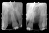 Figure 1  Pretreatment radiographs revealed convergent roots for the right canine and right central.