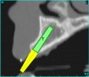 Figure 4a  CT scan data was input into the treatment-planning software, which allowed (A) placement of a simulated implant and (B) the determination of the “zone” for proper placement.