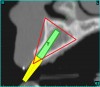 Figure 4b  CT scan data was input into the treatment-planning software, which allowed (A) placement of a simulated implant and (B) the determination of the “zone” for proper placement.