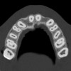 Figure 6a  By slicing the maxilla axially, the images revealed (A) the differing morphology of the central incisors, canines, premolar, and molar roots, and (B) the left simulated implant seen encroaching on the adjacent lamina dura.