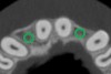 Figure 6b  By slicing the maxilla axially, the images revealed (A) the differing morphology of the central incisors, canines, premolar, and molar roots, and (B) the left simulated implant seen encroaching on the adjacent lamina dura.