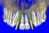 Figure 9a  Virtual implants were placed to determine the appropriate shape and type for the available space, in this case a tapered design allowed for adequate mesial-distal distance between adjacent roots.