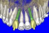 Figure 10a  By using the virtual teeth feature, (A) final implant and abutment positioning was checked, (B) the abutment projection evaluated for a cementable prosthesis, and (C) the appearance of the desired virtual restorations evaluated for emergence and esthetics.