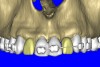 Figure 10c  By using the virtual teeth feature, (A) final implant and abutment positioning was checked, (B) the abutment projection evaluated for a cementable prosthesis, and (C) the appearance of the desired virtual restorations evaluated for emergence and esthetics.