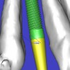 Figure 11a  By zooming in on the digital image, the implant-to-tooth distances can be assessed at the (A) crest and the (B) apex.