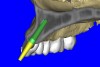 Figure 12a  (A) By sectioning the 3D model, virtual implant placement was assessed for the necessary 2 mm of facial and palatal bone surrounding the implant, and (B) by using segmentation techniques to remove the existing teeth, leaving the sockets, the alveolar complex was appreciated fully.