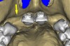 Figure 14a  The information gained from (A) the 3D model was confirmed when (B) the flaps were elevated.