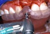 Figure 15b  A surgical template was derived from the final treatment plan created in the software, which facilitated (A) the drilling sequence and (B) precise location of placement.