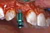 Figure 16b  After (A) the osteotomies were completed, (B) the implants were placed.