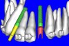 Figure 19a  A patient-specific abutment was designed in the software directly from the CT data.