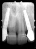 Figure 21  The final radiograph confirmed the fit of the abutment-implant-crown interfaces.