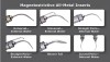 Figure 5  Selection of inserts and tips available for magnetostrictive and piezoelectric units which demonstrate a variety of designs for different clinical applications. (Photos courtesy of Parkell.)