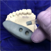 Fig 2. Silicone putty positioned over diagnostic wax-ups with holes placed exposing the wax-ups.