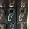 Fig 3. CBCT showing position of the wax-up, occlusal surface, and buccolingual contours.