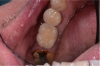 Fig 10. Cement-retained PFM crown.