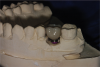 Fig 21. Definitive restoration on cast, buccal view.