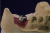 Fig 23. Custom titanium abutment in screw-cementable case.