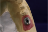 Fig 24. Screw-access hole positioned slightly buccal.