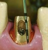 Fig 9. Using a soft-tissue model and a periodontal probe, an abutment margin depth can be accurately located.