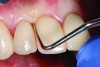 Fig 16 and Fig 17. With the implant restoration on tooth No. 8, the interproximal bone on the mesial of Nos. 7 (Fig 16) and 9 (Fig 17) can be sounded to verify the appropriate contact point placement from the proximal crest of bone to ensure complete regeneration of the interproximal papilla. (Photographs courtesy of Don Jayne, DDS)