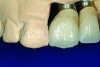 Fig 18. The difficulties of using a stock abutment to restore anterior teeth are evident. Because the abutment profile was insufficient, the margins were lowered to allow more room to develop the emergence profile.