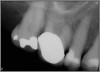 Fig 1. Foreshortened PA radiograph.