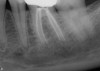 Fig 4. Endodontic therapy on molar with four canals.