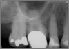 Fig 2. Acceptable PA radiograph.