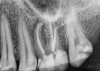 Fig 7. Conservative access does not prevent the “popping” of six or seven lateral canals on this particular molar.
