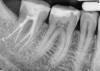 Fig 8. Complex four canals with internal resorption in distal canals.