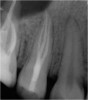 Fig 10. Despite tiny access, three canals were negotiated in this difficult premolar.