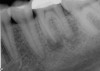 Fig 15. Molar with significant radiolucencies.