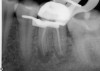 Fig 16. Mesial-lingual (ML) length looks to be precise, while distal-lingual (DL) looks to be slightly long.