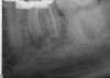 Fig 17. Mesial-buccal (MB) length appears to be long, and distal-buccal (DB) has a kink likely due to its joining the DL canal just before the apex.