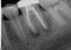 Fig 18. Completed case shows how the lengths were corrected prior to final obturation to achieve an ideal result.