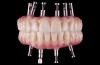 Fig 16. Machined CL-IIIb zirconia framework prior to coloration and final sintering (Fig 15); colorized and final sintered monolithic CL-IIIb zirconia restoration (Fig 16) (images courtesy of Enrico Steger/Zirkonzahn).