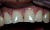 Dental erosion caused by chewable amino acid supplements in a 30-year-old body builder.
