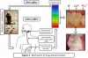 Mechanism of drug-induced erosion.