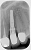 Fig 7. Ill-fitting milled abutment obtained from a third-party vendor and not from the manufacturer.