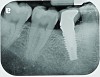 Fig 13. Radiograph depicting peri-implantitis.