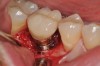 Fig 15. Implant abutment following cement removal.